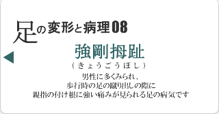 強剛拇趾
