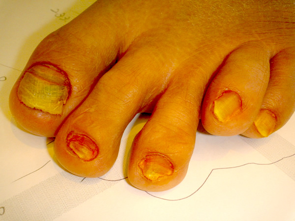 爪水虫 爪白癬 はくせん 足の変形と病理 横浜のオーダー健康靴プロフィットイイジマ