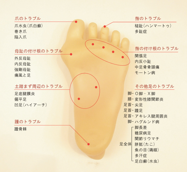 の 黒い 足 点 裏 昨日足に激痛が・・・見てみると黒い点のようなものがありました。これ